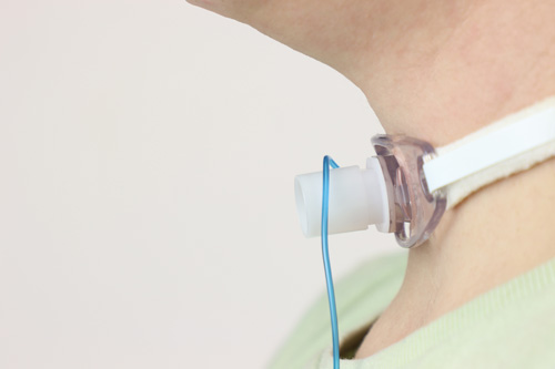 Показания к установке трахеостомы