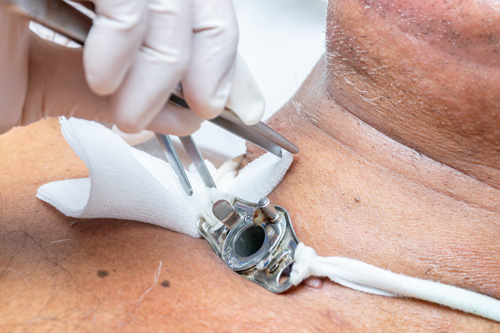 Как ставят трахеостому