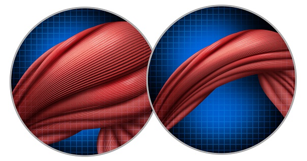 Злокачественная кахексия