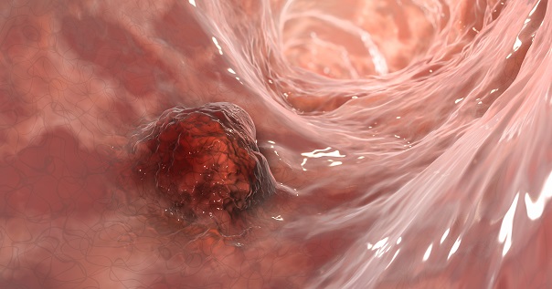 Малигнизация