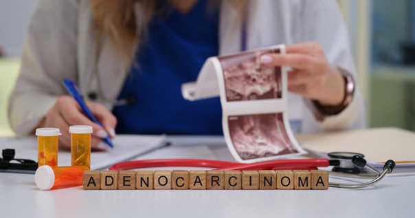 Аденокарцинома
