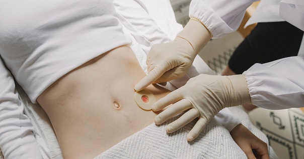 Стома при раке