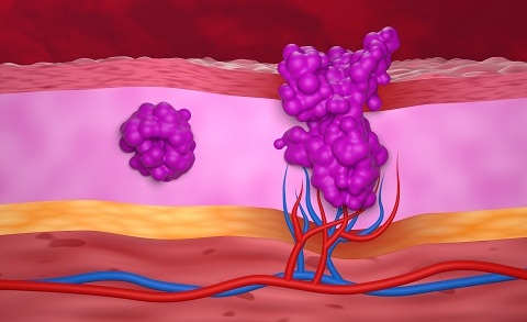 Классификация плоскоклеточного рака кожи