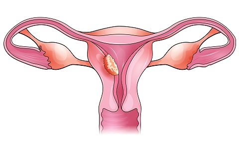 Аденокарцинома матки