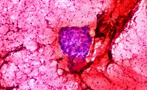 Классификация саркомы Юинга