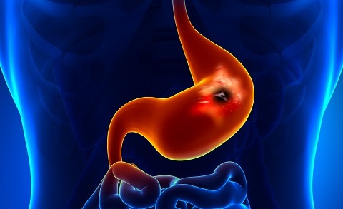 Аденокарцинома желудка