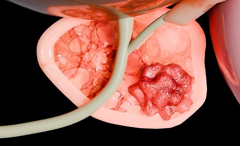 Классификация аденокарциномы предстательной железы
