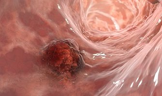 Малигнизация