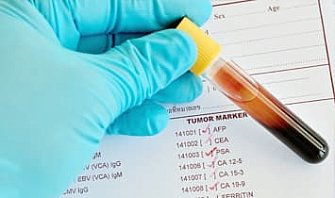 Онкомаркеры: виды, значения и роль в диагностике рака