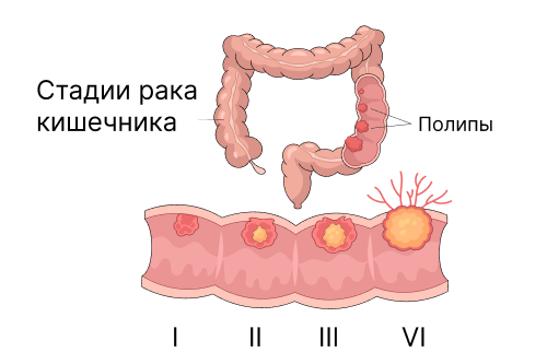 Стадии рака Стадии рака