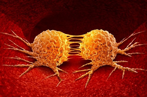 Что такое вторичная опухоль (метастаз)