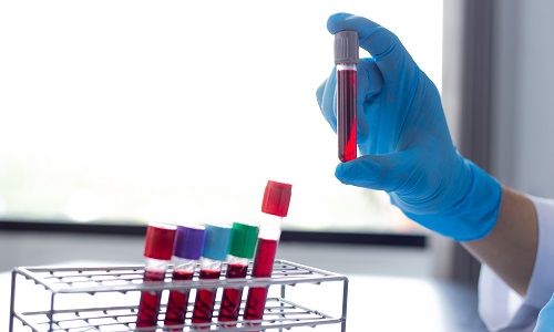 Диагностика кахексии при раке