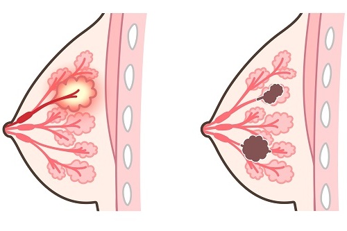 HER2-позитивный рак молочной железы