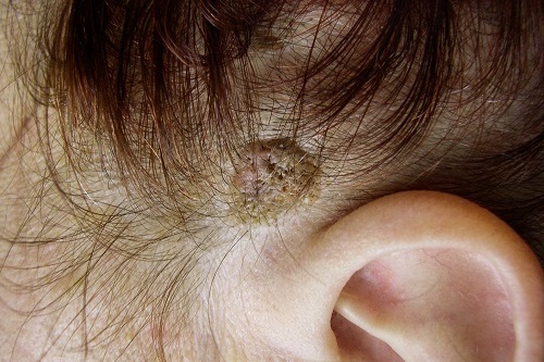 Симптомы кератомы