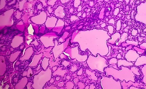 Стадии синовиальной саркомы
