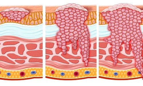 Развитие карциномы