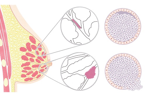Карцинома in situ молочной железы