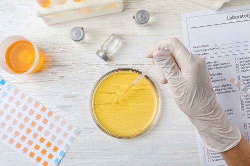 Диагностика лучевого цистита Диагностика лучевого цистита