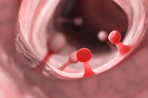 Симптомы малигнизации Симптомы малигнизации