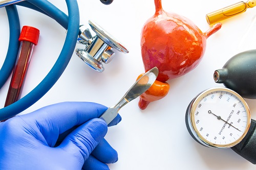 Карцинома in situ мочевого пузыря